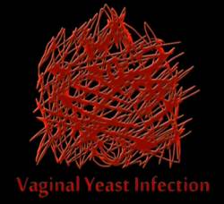 Vaginal Yeast Infection